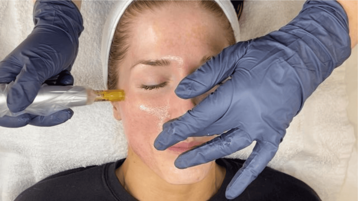 Microneedling